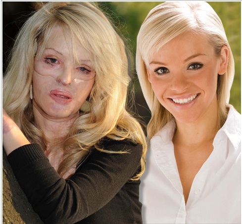 Back in 2008 gorgeous up and coming model Katie Piper was attacked by her ex